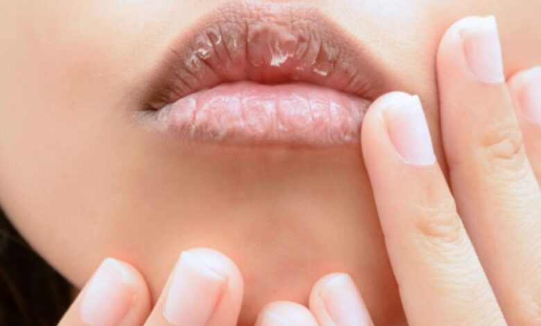 Cara alami atasi bibir kering juga pecah-pecah agar tampil percaya diri